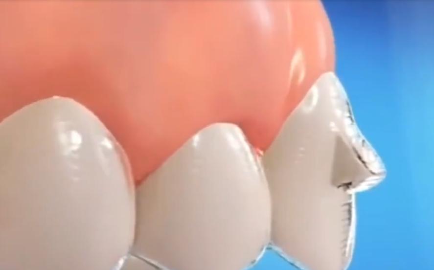 隐形牙套和透明保持器的区别,牙齿保持器和隐形牙套的区别