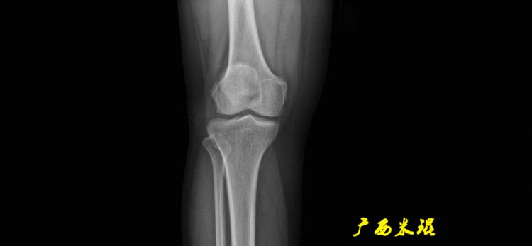 广西骨科医生米琨最新信息,米琨广西骨科什么水平