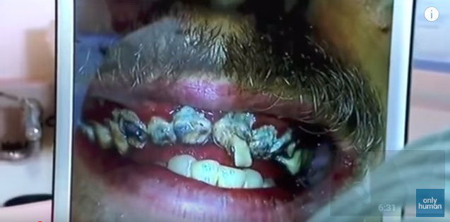 小孩长期不刷牙后果真实视频,长时间不刷牙竟然这么可怕
