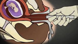 三分钟无痛人流的原理,三分钟无痛人流