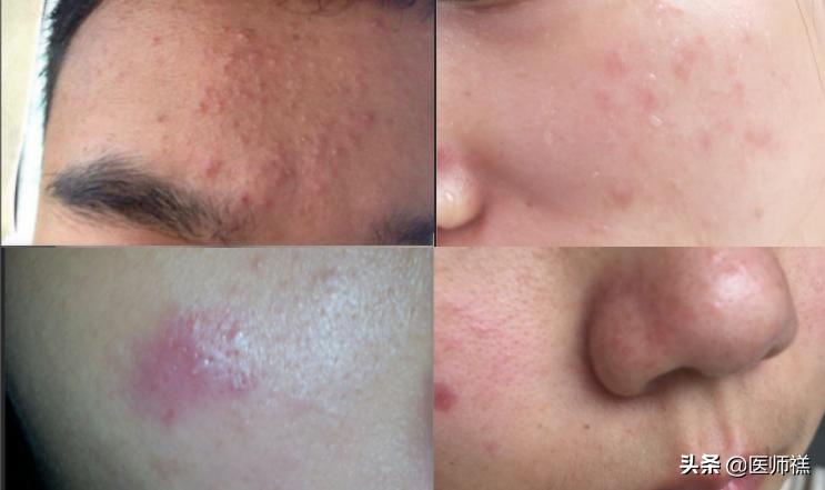 脸上长痘痘缺乏什么维生素,缺少维生素脸上的表现