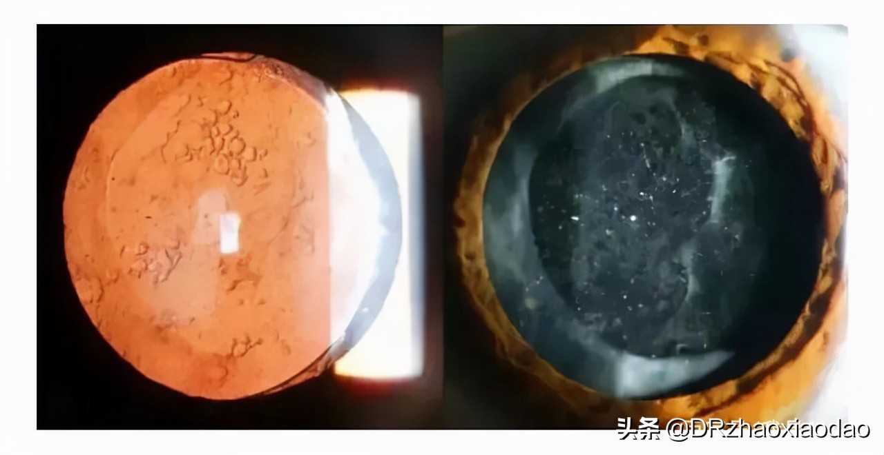 白内障手术人工晶体选择,白内障手术人工晶体是怎么做的