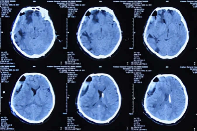 脑外伤开颅手术后脑积水,脑外伤手术后脑脊液鼻漏怎么治疗