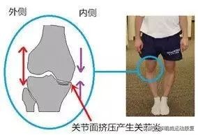 o型腿的自我鉴别及矫正方法,怎么知道o型腿是不是在慢慢变好