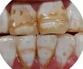 你的牙齿变黄了怎么办,你的牙齿为什么会那么白