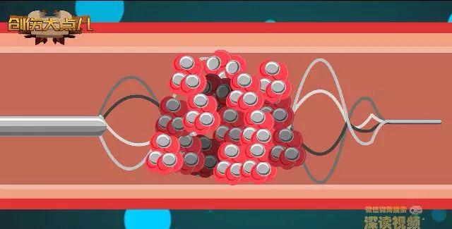 得了脑血管堵塞怎么办,脑血管堵塞了有什么办法吗