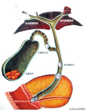 肚子疼真的那么简单吗？——慢性腹痛的一点点点的事