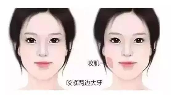 面部咬肌肥大怎么去除,脸部咬肌怎么消除整形