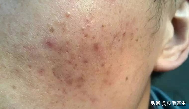 褐斑祛斑最有效方法,年轻人脸上长褐斑老年斑如何治疗