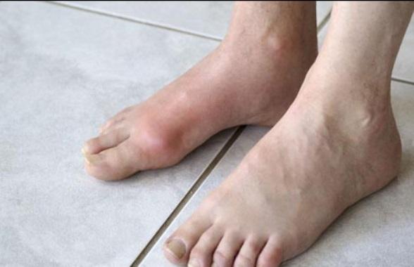 脚上有病有什么征兆,脚上有这三种症状赶紧去医院