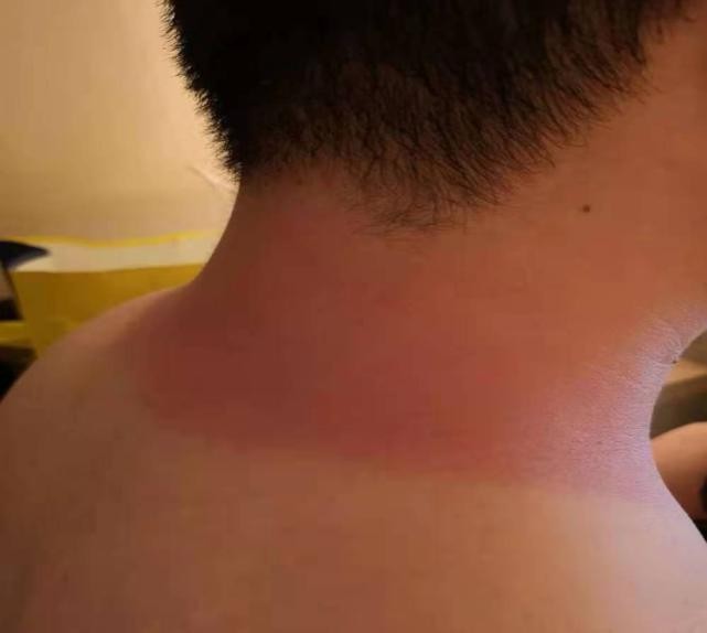 炎炎夏日谨防三类常见病,炎炎夏日谨防空调病