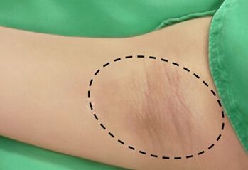 狐臭是一种生理现象么,狐臭是什么病引起的