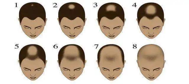 脱发请认真止脱,脱发人群的十个问题