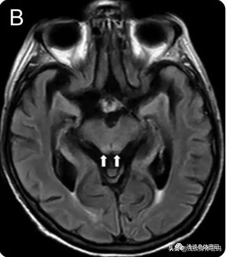 甲硝唑中毒可逆吗,甲硝唑中毒性脑病ct表现