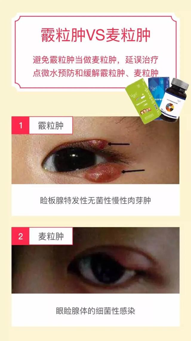 眼皮上长痘是麦粒肿吗,眼皮长痘是针眼吗