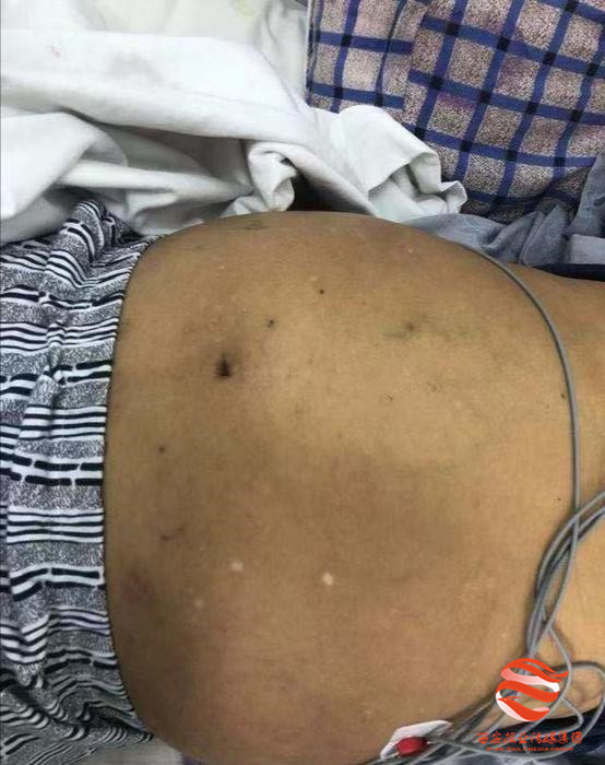 静脉曲张综合征常见皮肤表现,布加氏综合征与静脉曲张有关系吗