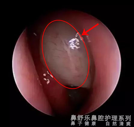 现在怎么那么多鼻炎馆,专门的鼻炎馆管用吗