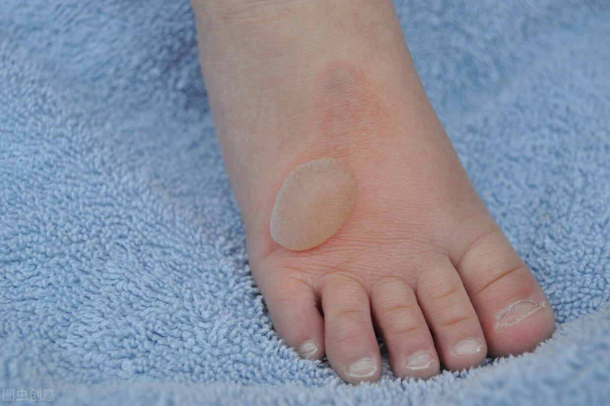 涂牙膏、抹猪油、敷蛋清、铺面粉？你真的知道怎样处理烧烫伤吗？