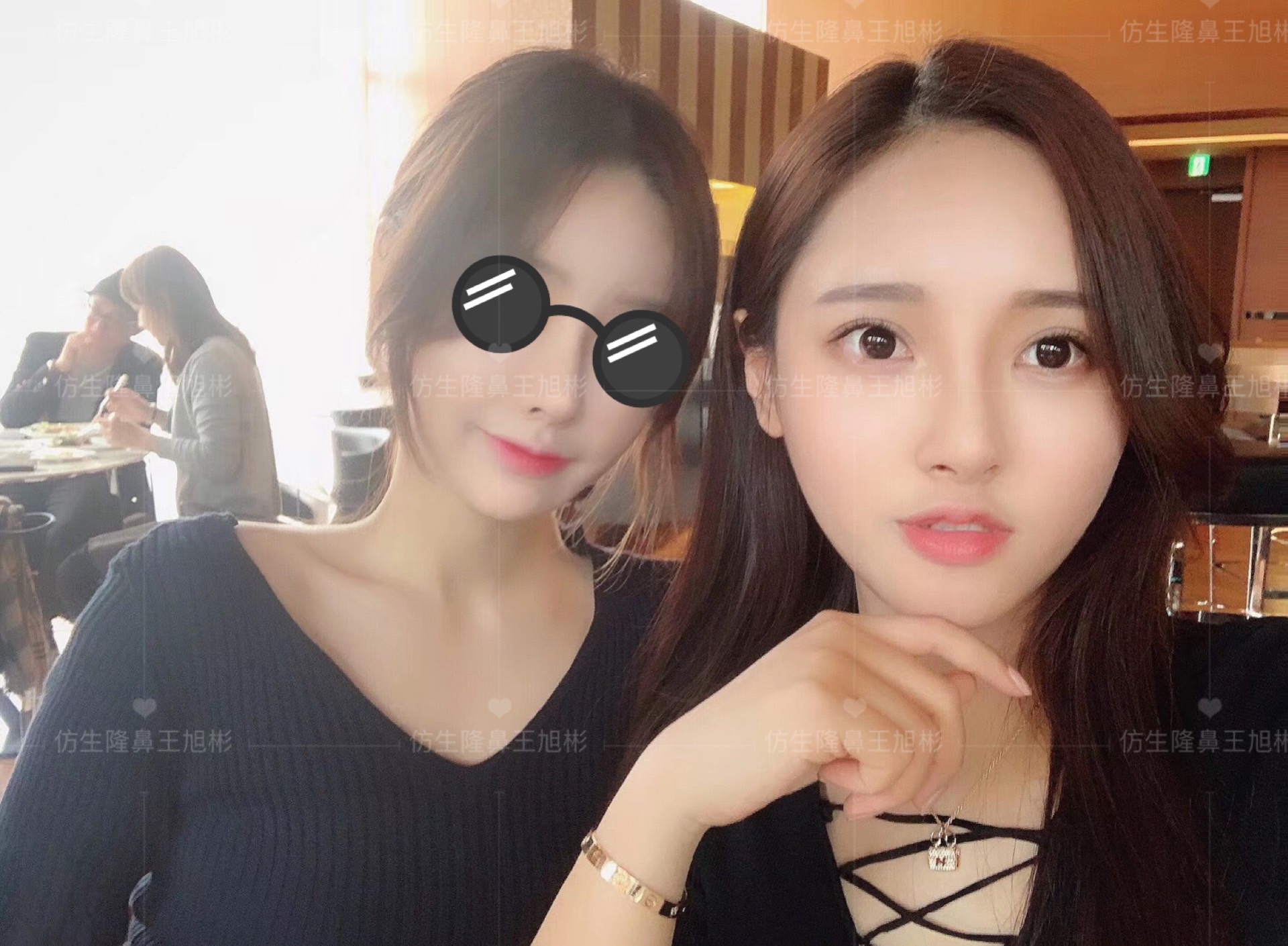 线雕隆鼻后鼻综合修复术,隆鼻失败修复手术真实案例