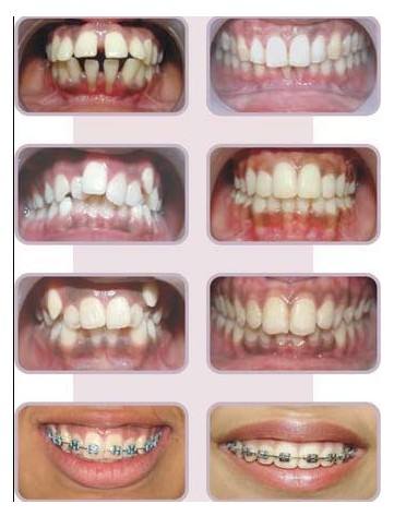 牙齿矫正地包天前突前后对比图,龅牙牙齿矫正的最佳方法