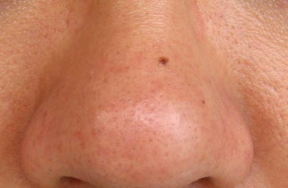 皮肤黑头有什么小偏方治,竹炭祛黑头面膜能去除黑头吗