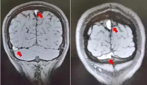 熬夜加班后脑袋疼,26岁小伙熬夜加班后头晕