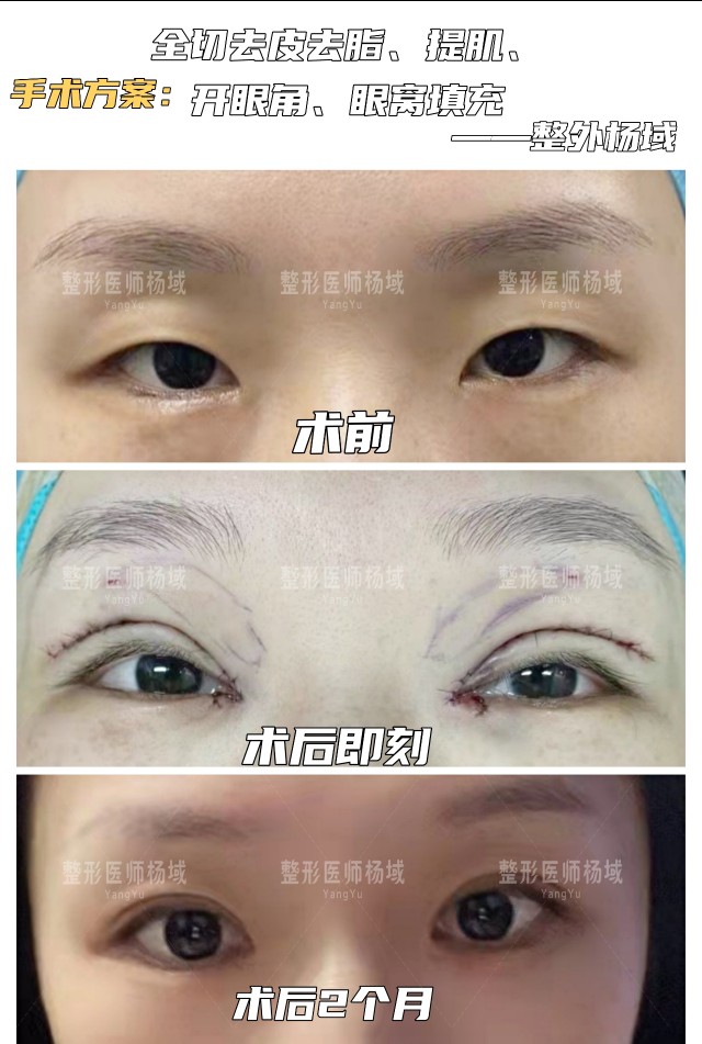 眼部整形科普合集,整形眼综合科普知识