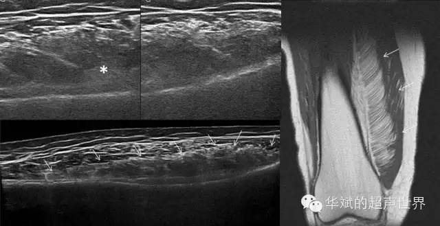 纤维脂肪瘤属于什么类型的疾病,特殊类型脂肪瘤