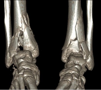 科普丨什么是Pilon骨折？