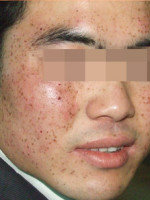 激光祛雀斑后每天变化图,激光祛雀斑反弹几率大吗