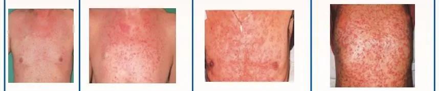 地舒单抗不良反应甲沟炎,皮肤免疫抑制剂治疗湿疹