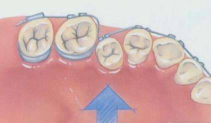 牙齿矫正能不能出现新的矫正方法,牙齿矫正一般是矫正什么情况