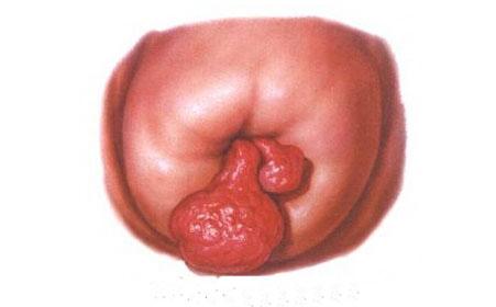 绝经后出血警惕四种疾病,绝经后出血当心卵巢癌