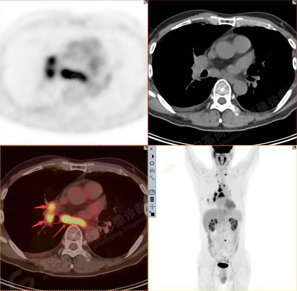 petct检查报告肺结节考虑恶性肿瘤,30mm肺结节pet显示没有转移