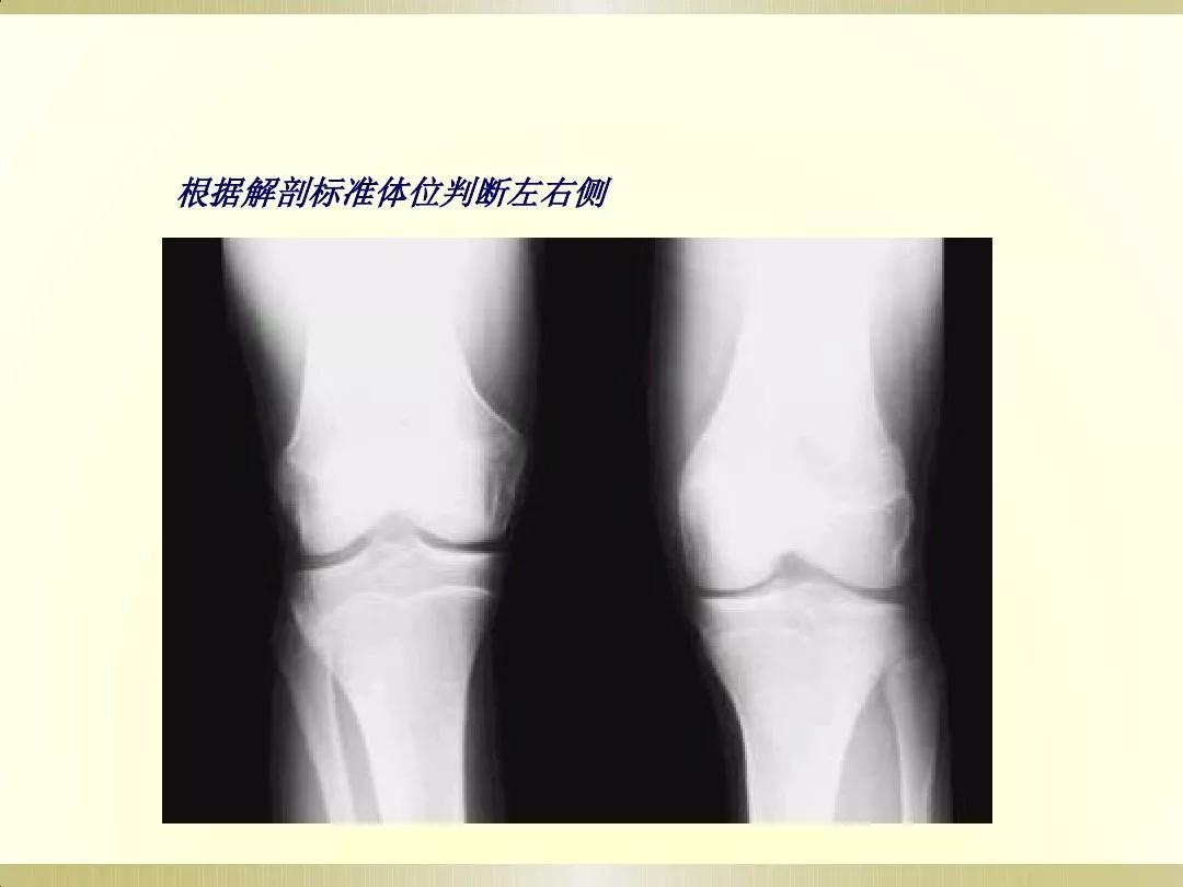 骨科x光片读片技巧,放射科骨科读片教程