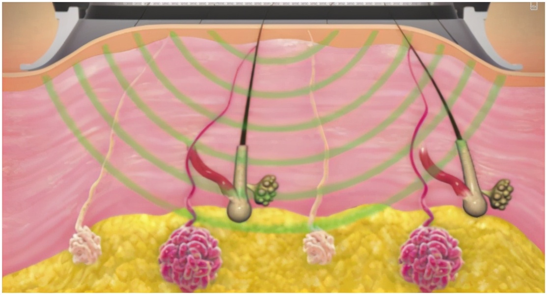 狐臭是怎么引起的,狐臭是怎么引起的啊