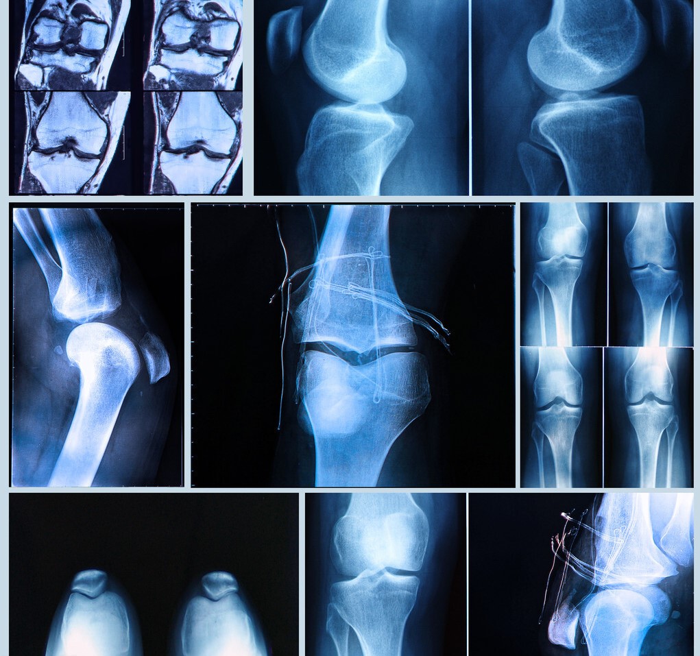 治疗腿疼的氨糖有哪些,腿疼长期吃氨糖可以吗