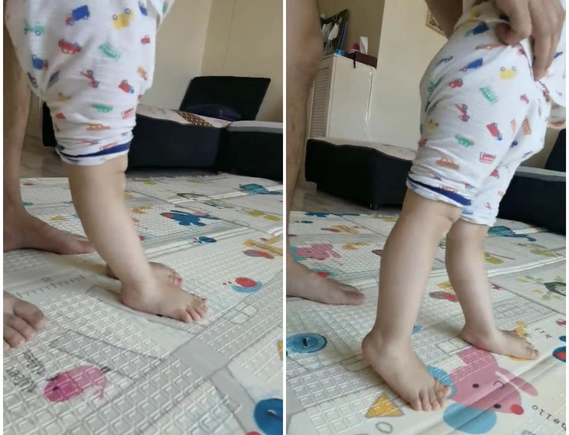 运动足外翻怎么矫正,运动引起脚大拇指外翻怎么矫正