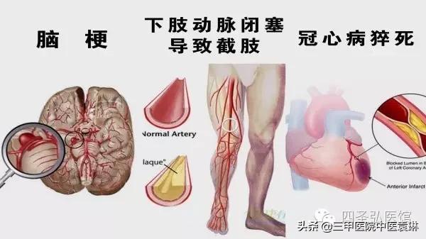 中医能治疗抑郁症焦虑症吗,中医怎样看待焦虑症和抑郁症