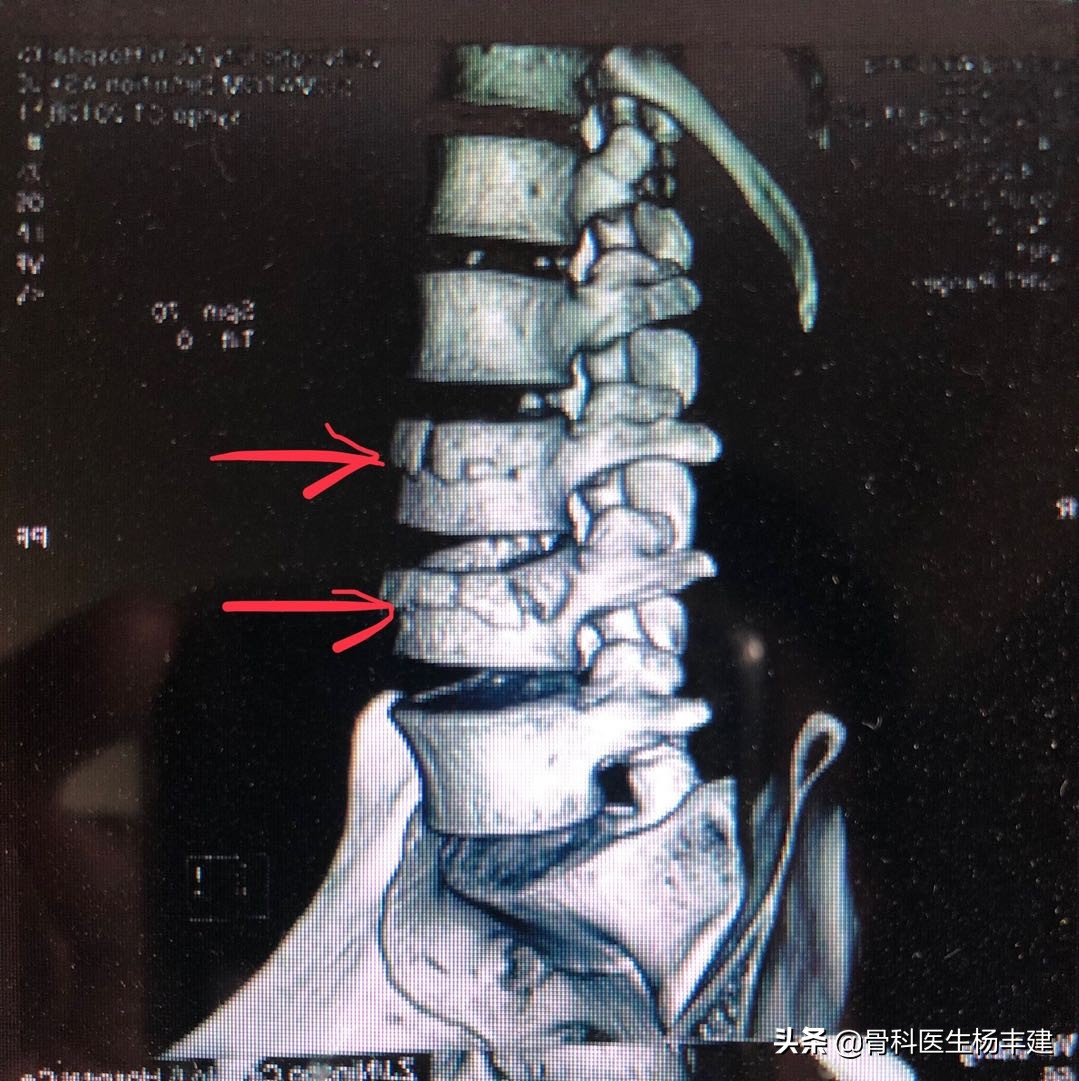 老人摔小腿骨折要手术吗,老年人腰椎压缩性骨折需住院多久