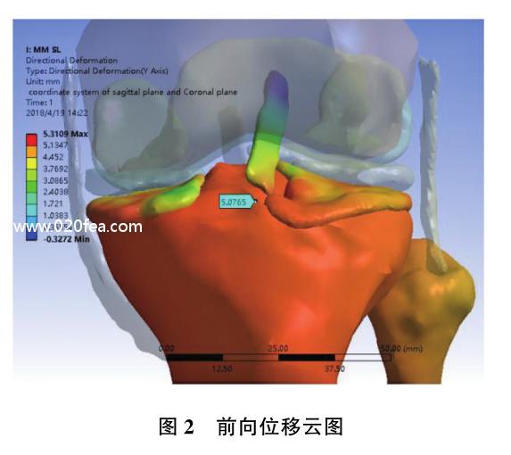 半月板后角二度真实模型,内侧半月板后角结构图