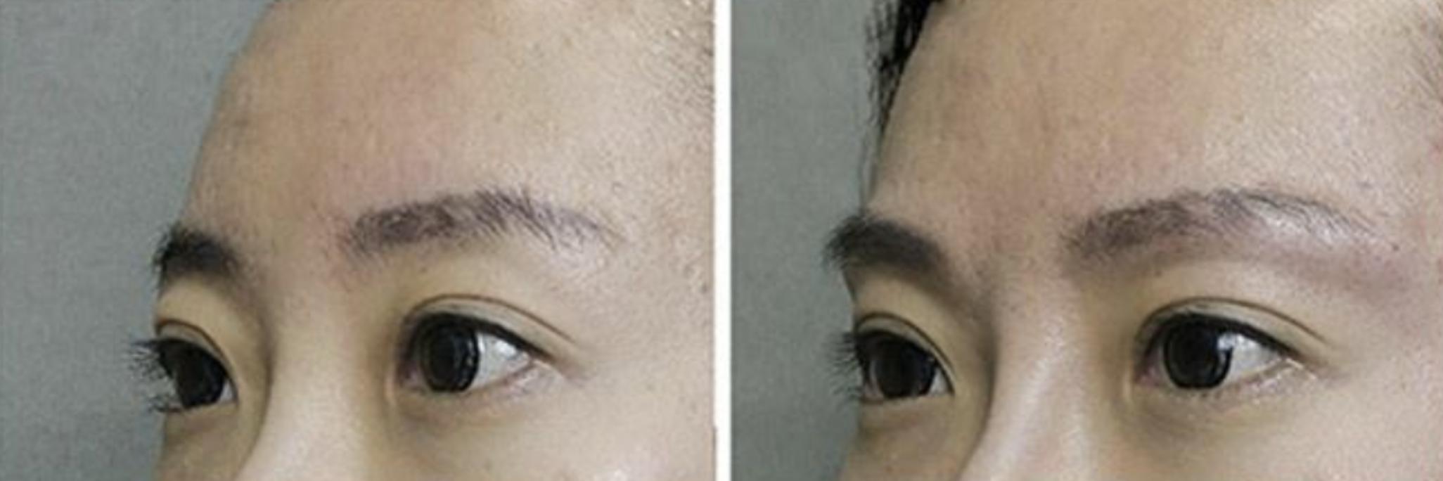 怎样让五官变立体整形,五官轮廓整形