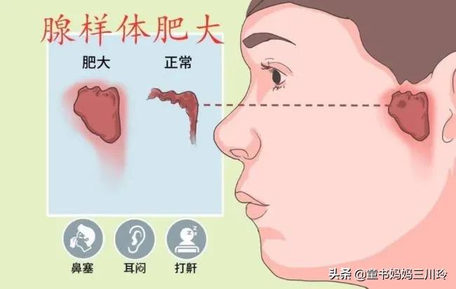 孩子睡觉打呼噜14岁,小朋友晚上睡觉打呼噜怎么治好