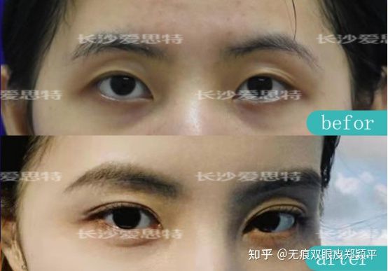 刚割双眼皮的样子,割双眼皮增生是什么样子