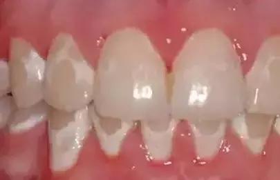 11个月牙齿脱矿龋齿如何补救,龋齿脱矿用含氟牙膏多久有效果