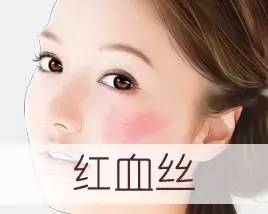 揭秘改善红血丝的四大方法,5个小妙招彻底告别红血丝