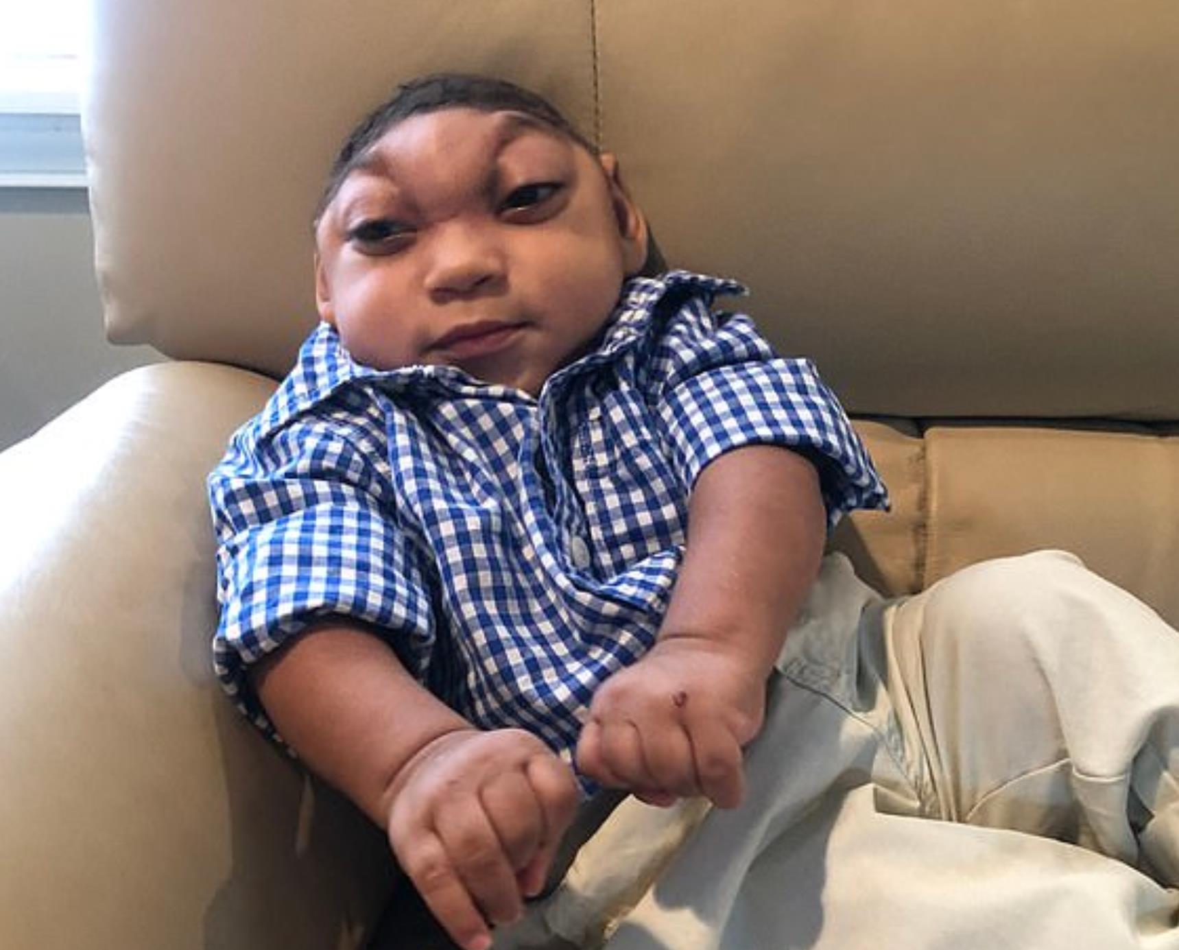 小头畸形的孩子能活多久,孩子出生畸形可以放弃吗