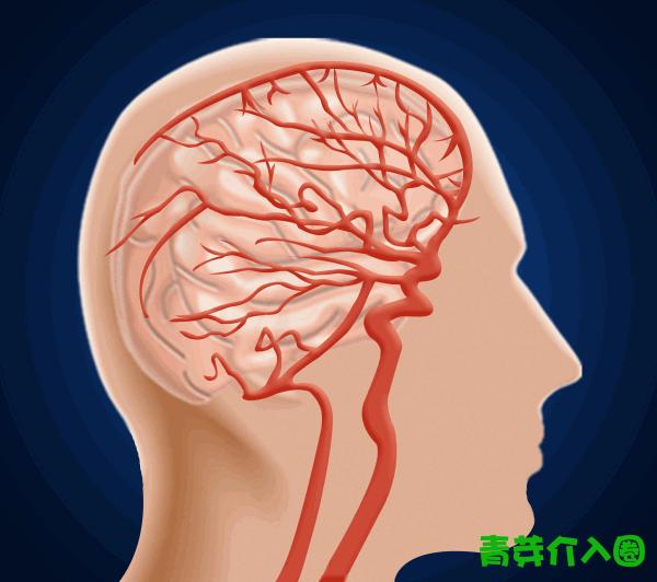 颅内动脉瘤介入栓塞支架全过程,颅内夹层动脉瘤介入演示