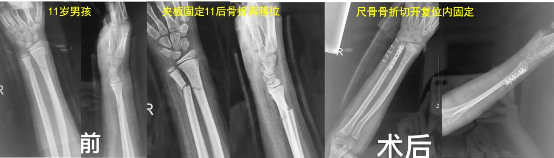 两个儿童前臂骨折争议病例之——元芳你怎么看