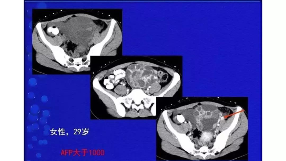 卵巢原发肿瘤的分析思路